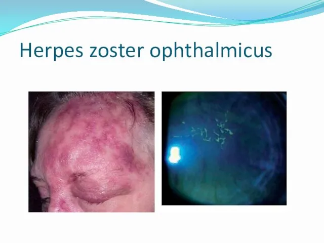 Herpes zoster ophthalmicus