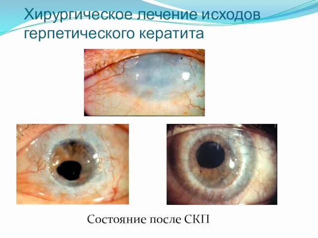 Хирургическое лечение исходов герпетического кератита Состояние после СКП