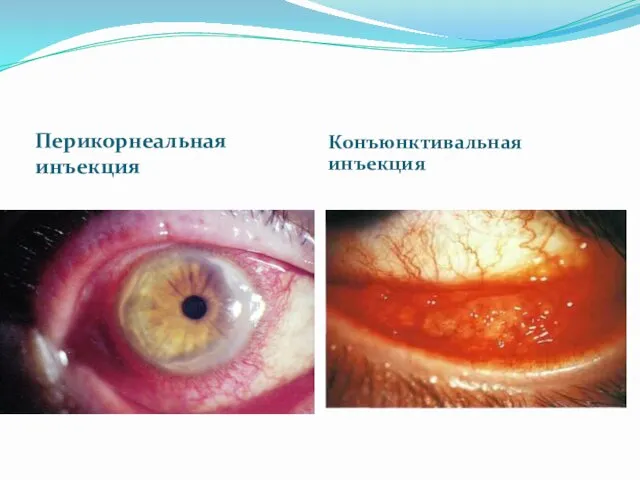 Перикорнеальная инъекция Конъюнктивальная инъекция