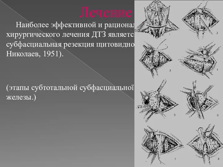 Лечение Наиболее эффективной и рациональной методикой хирургического лечения ДТЗ является субтотальная субфасциальная резекция