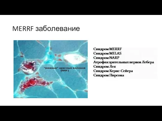 MERRF заболевание