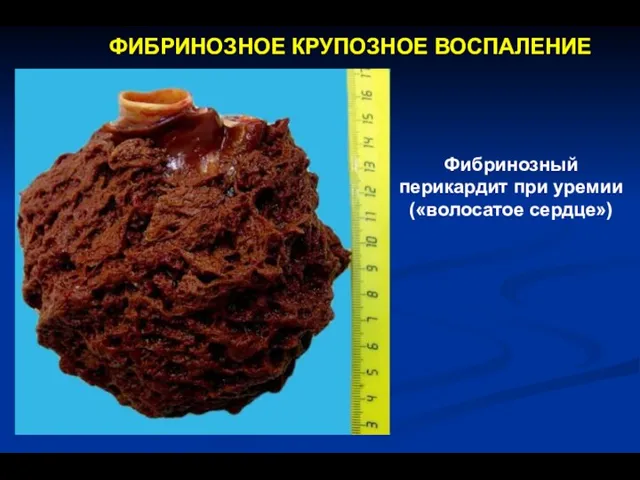 ФИБРИНОЗНОЕ КРУПОЗНОЕ ВОСПАЛЕНИЕ Фибринозный перикардит при уремии («волосатое сердце»)