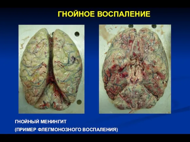 ГНОЙНОЕ ВОСПАЛЕНИЕ ГНОЙНЫЙ МЕНИНГИТ (ПРИМЕР ФЛЕГМОНОЗНОГО ВОСПАЛЕНИЯ)