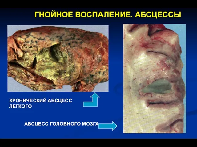 ГНОЙНОЕ ВОСПАЛЕНИЕ. АБСЦЕССЫ ХРОНИЧЕСКИЙ АБСЦЕСС ЛЕГКОГО АБСЦЕСС ГОЛОВНОГО МОЗГА