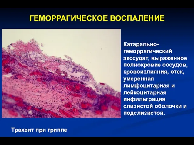 ГЕМОРРАГИЧЕСКОЕ ВОСПАЛЕНИЕ Катарально-геморрагический экссудат, выраженное полнокровие сосудов, кровоизлияния, отек, умеренная