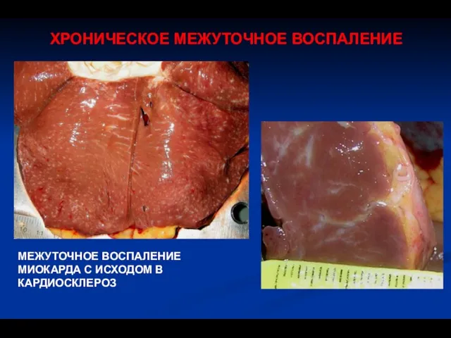 ХРОНИЧЕСКОЕ МЕЖУТОЧНОЕ ВОСПАЛЕНИЕ МЕЖУТОЧНОЕ ВОСПАЛЕНИЕ МИОКАРДА С ИСХОДОМ В КАРДИОСКЛЕРОЗ