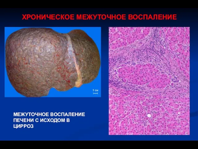 ХРОНИЧЕСКОЕ МЕЖУТОЧНОЕ ВОСПАЛЕНИЕ МЕЖУТОЧНОЕ ВОСПАЛЕНИЕ ПЕЧЕНИ С ИСХОДОМ В ЦИРРОЗ