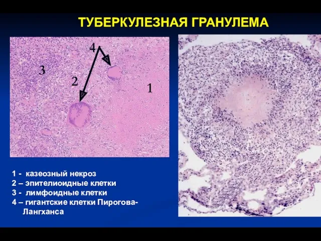 ТУБЕРКУЛЕЗНАЯ ГРАНУЛЕМА 1 2 3 1 - казеозный некроз 2