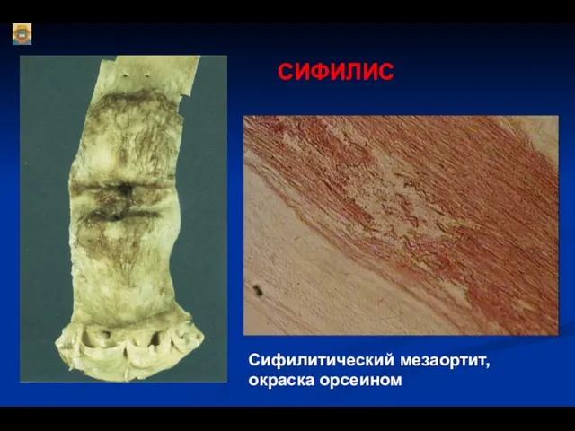 СИФИЛИС Сифилитический мезаортит, окраска орсеином