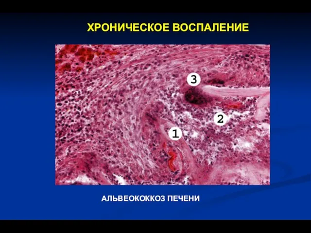 ХРОНИЧЕСКОЕ ВОСПАЛЕНИЕ АЛЬВЕОКОККОЗ ПЕЧЕНИ