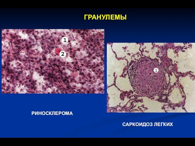 ГРАНУЛЕМЫ РИНОСКЛЕРОМА САРКОИДОЗ ЛЕГКИХ