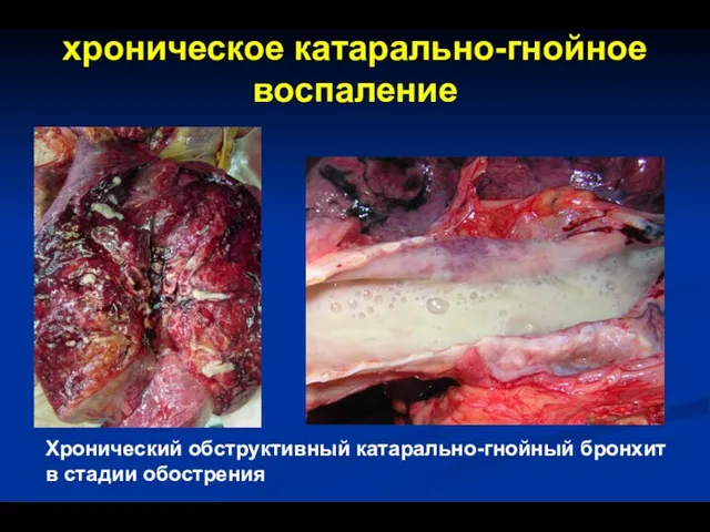 хроническое катарально-гнойное воспаление Хронический обструктивный катарально-гнойный бронхит в стадии обострения