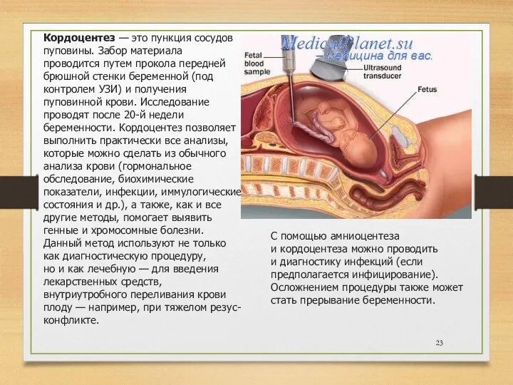 Кордоцентез — это пункция сосудов пуповины. Забор материала проводится путем