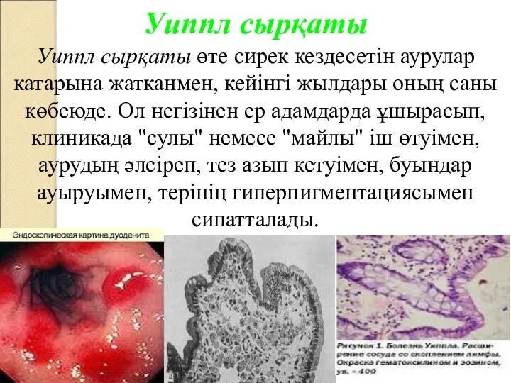 Уиппл сырқаты Уиппл сырқаты өте сирек кездесетін аурулар катарына жатканмен,