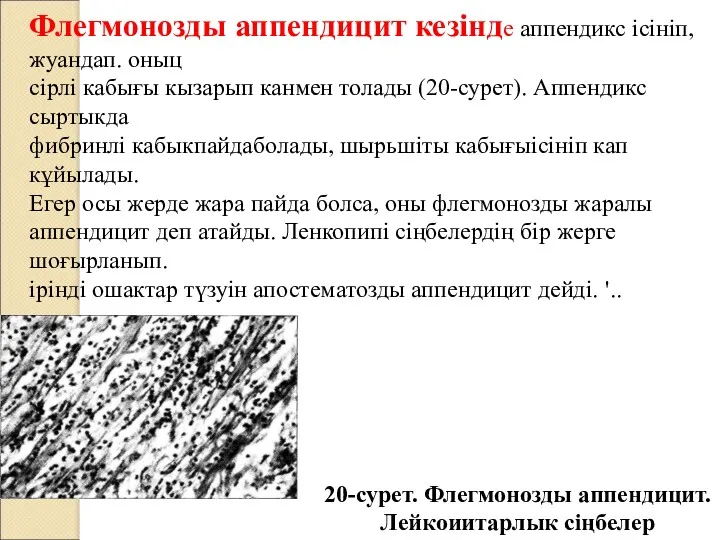 Флегмонозды аппендицит кезінде аппендикс ісініп, жуандап. оныц сірлі кабығы кызарып