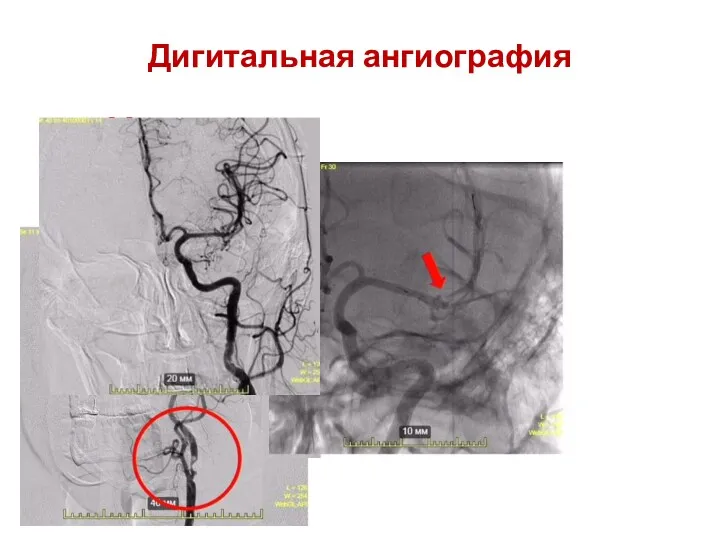 Дигитальная ангиография