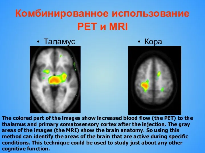 Комбинированное использование PET и MRI Таламус Кора The colored part of the images