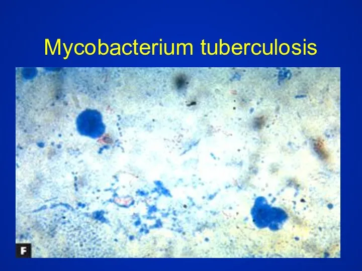 Mycobacterium tuberculosis