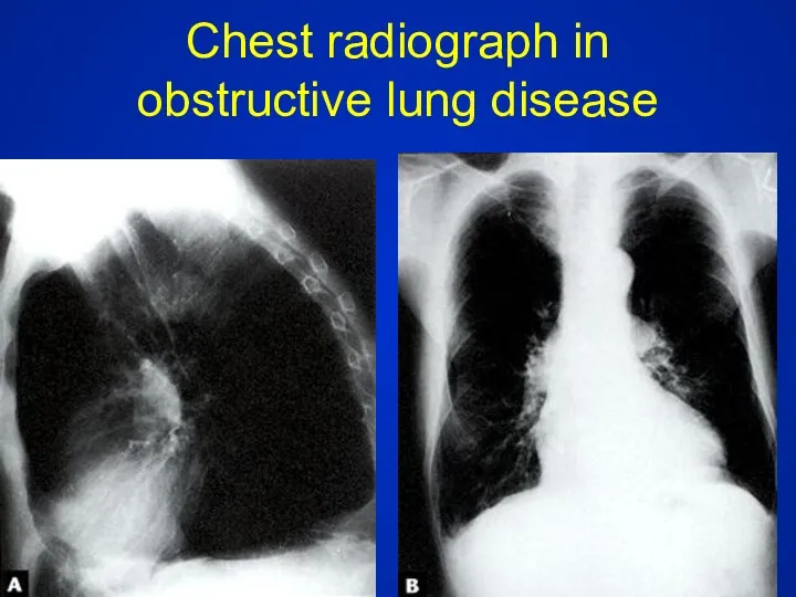 Chest radiograph in obstructive lung disease