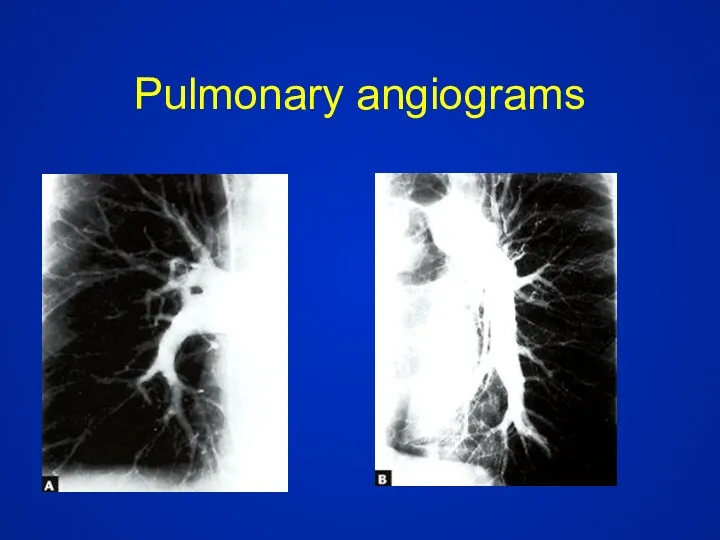 Pulmonary angiograms