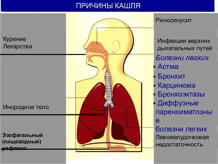 ПРИЧИНЫ КАШЛЯ Курение Лекарства Эзофагальный (пищеводный) рефлюкс Инородное тело Риносинусит