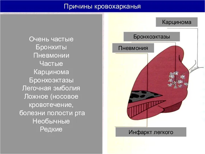 Причины кровохарканья Пневмония Бронхоэктазы Карцинома Инфаркт легкого Очень частые Бронхиты