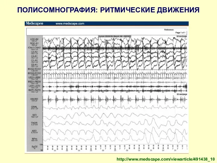 ПОЛИСОМНОГРАФИЯ: РИТМИЧЕСКИЕ ДВИЖЕНИЯ http://www.medscape.com/viewarticle/491438_10