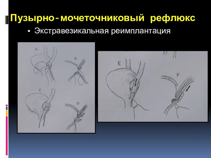 Пузырно-мочеточниковый рефлюкс Экстравезикальная реимплантация