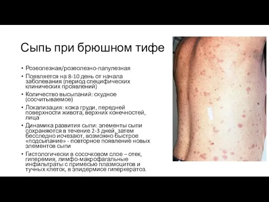 Сыпь при брюшном тифе Розеолезная/розеолезно-папулезная Появляется на 8-10 день от