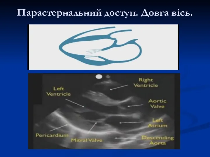 Парастернальний доступ. Довга вісь.