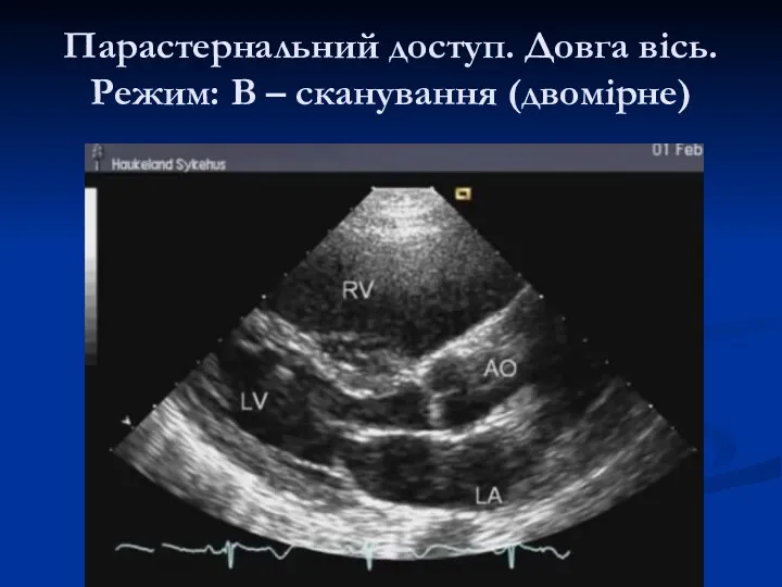 Парастернальний доступ. Довга вісь. Режим: В – сканування (двомірне)