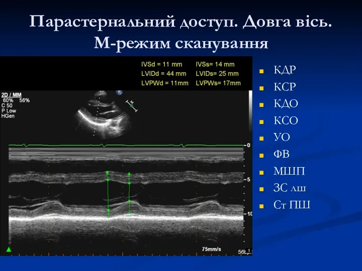 Парастернальний доступ. Довга вісь. М-режим сканування КДР КСР КДО КСО