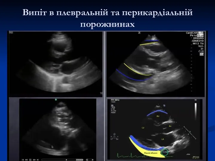 Випіт в плевральній та перикардіальній порожнинах