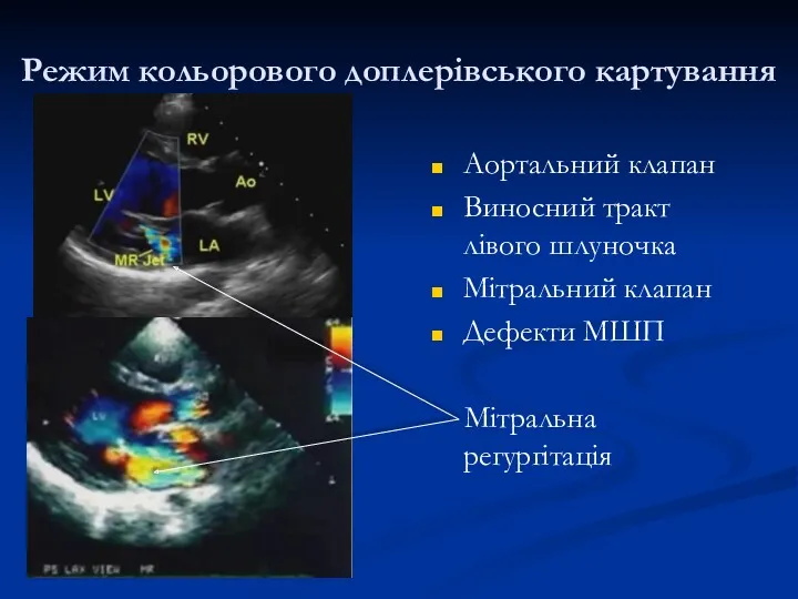 Режим кольорового доплерівського картування Аортальний клапан Виносний тракт лівого шлуночка Мітральний клапан Дефекти МШП Мітральна регургітація