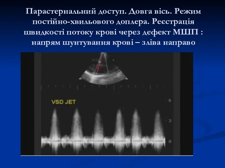 Парастернальний доступ. Довга вісь. Режим постійно-хвильового доплера. Реєстрація швидкості потоку