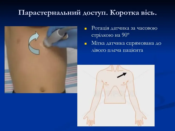 Парастернальний доступ. Коротка вісь. Ротація датчика за часовою стрілкою на