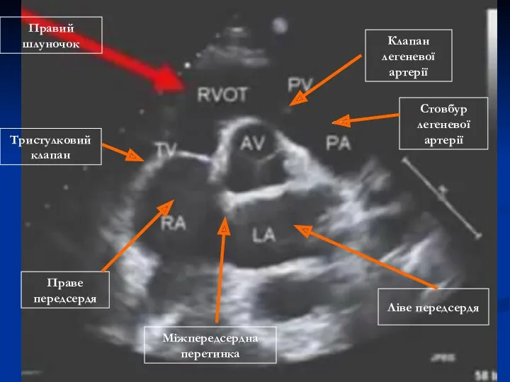 Правий шлуночок Міжпередсердна перетинка Ліве передсердя Праве передсердя Стовбур легеневої артерії Клапан легеневої артерії Тристулковий клапан