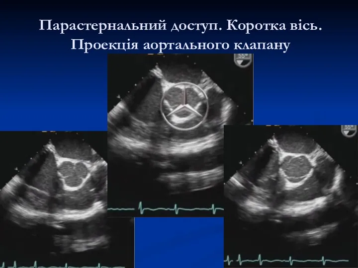 Парастернальний доступ. Коротка вісь. Проекція аортального клапану