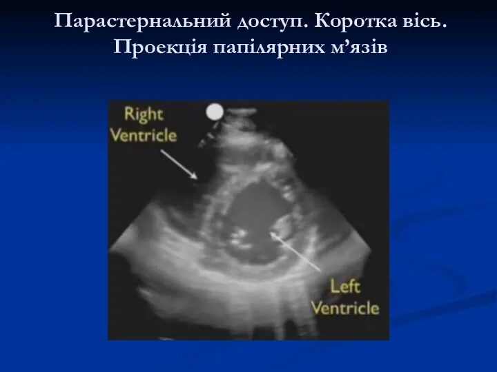 Парастернальний доступ. Коротка вісь. Проекція папілярних м’язів