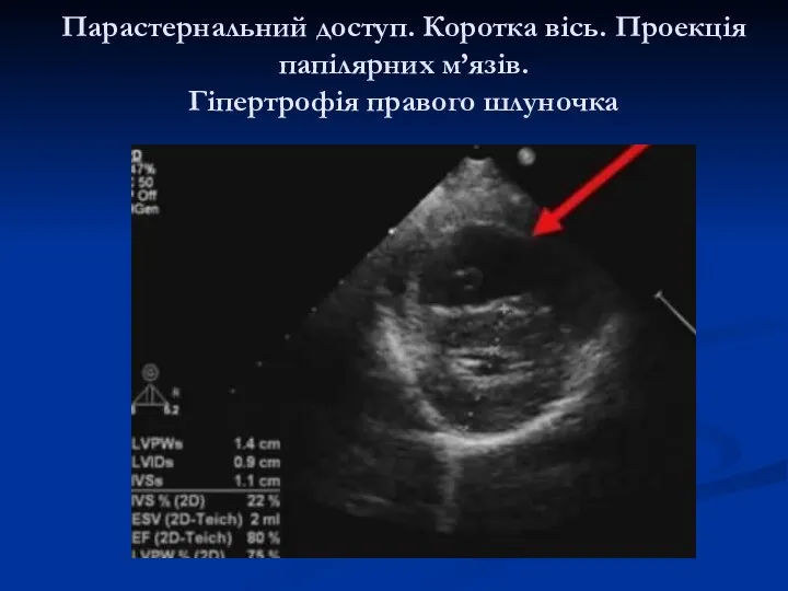 Парастернальний доступ. Коротка вісь. Проекція папілярних м’язів. Гіпертрофія правого шлуночка