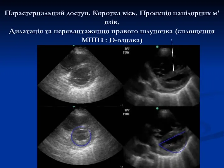 Парастернальний доступ. Коротка вісь. Проекція папілярних м’язів. Дилатація та перевантаження правого шлуночка (сплощення МШП : D-ознака)