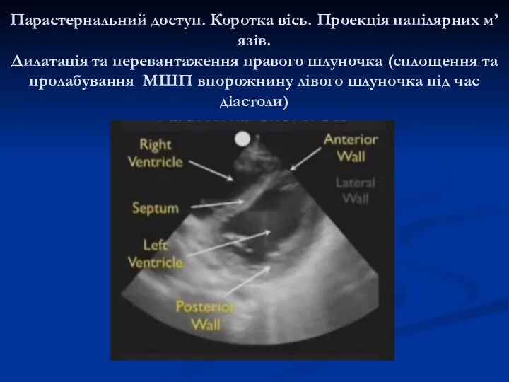 Парастернальний доступ. Коротка вісь. Проекція папілярних м’язів. Дилатація та перевантаження