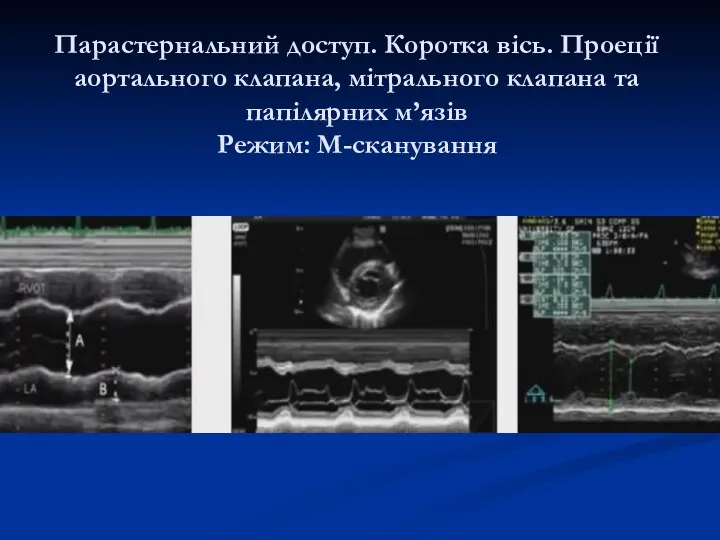 Парастернальний доступ. Коротка вісь. Проеції аортального клапана, мітрального клапана та папілярних м’язів Режим: М-сканування