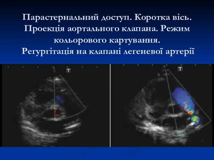 Парастернальний доступ. Коротка вісь. Проекція аортального клапана. Режим кольорового картування. Регургітація на клапані легеневої артерії