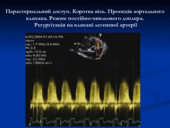 Парастернальний доступ. Коротка вісь. Проекція аортального клапана. Режим постійно-хвильового доплера. Регургітація на клапані легеневої артерії