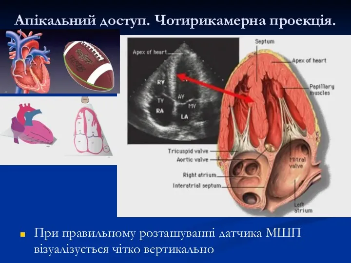 Апікальний доступ. Чотирикамерна проекція. При правильному розташуванні датчика МШП візуалізується чітко вертикально