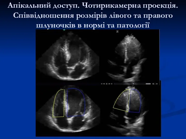 Апікальний доступ. Чотирикамерна проекція. Співвідношення розмірів лівого та правого шлуночків в нормі та патології
