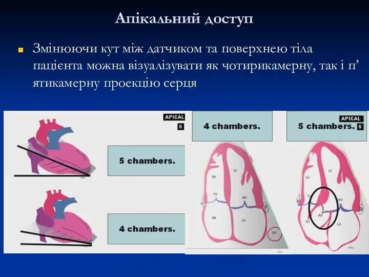 Апікальний доступ Змінюючи кут між датчиком та поверхнею тіла пацієнта