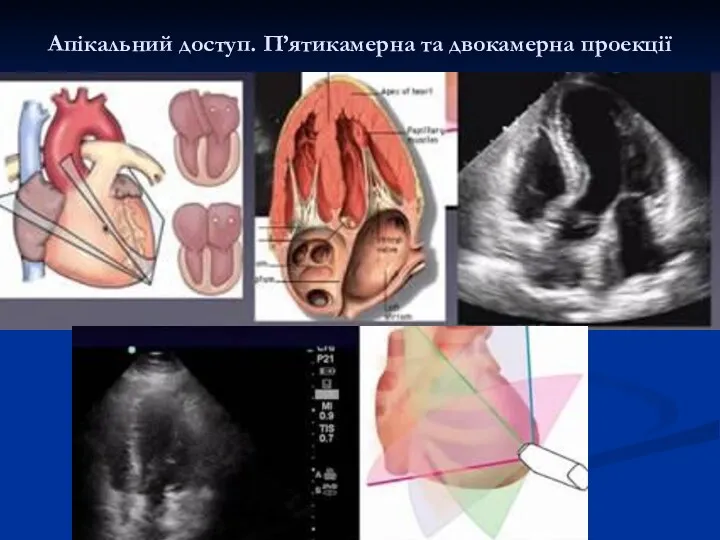 Апікальний доступ. П’ятикамерна та двокамерна проекції