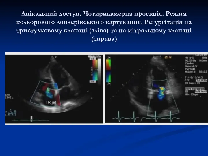 Апікальний доступ. Чотирикамерна проекція. Режим кольорового доплерівського картування. Регургітація на